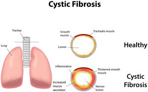 cystic-fibrosis-lung
